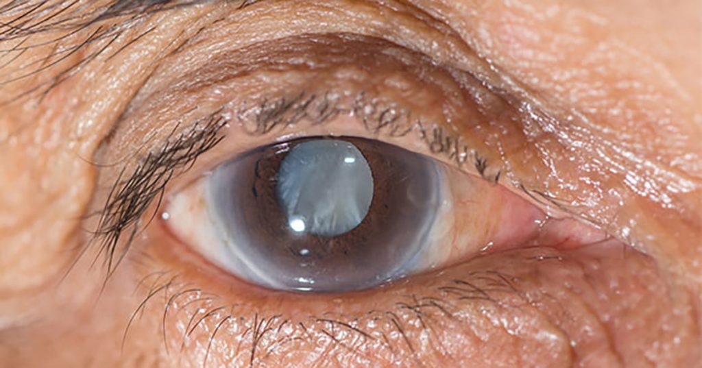 Five Foods That May Increase the Risk of Cataracts