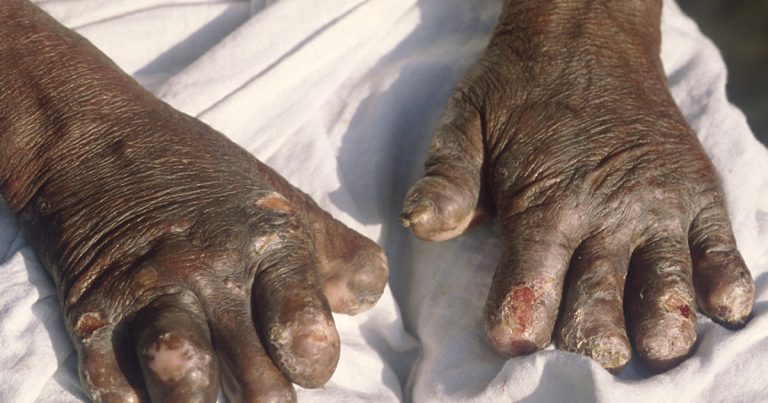 Leprosy Cases Remain Above Target Threshold in 16 Districts